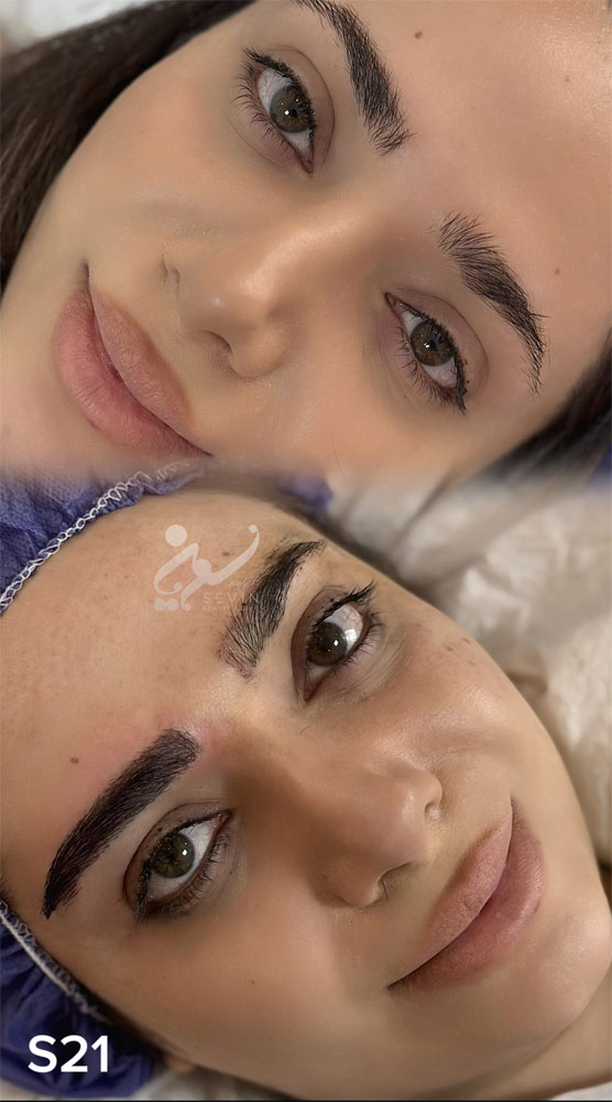 نمونه کاشت ابرو در کلینیک سوین